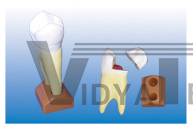 The model of maxillary 2roots caries (2 parts)